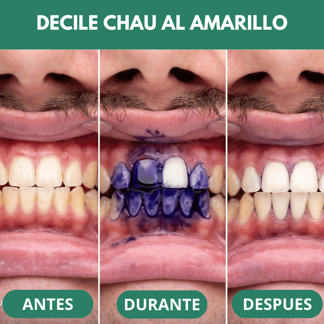 DentesLixívia™ - Blanqueador Dental v34 (COMPRA 1 Y LLÉVATE 1 GRATIS)